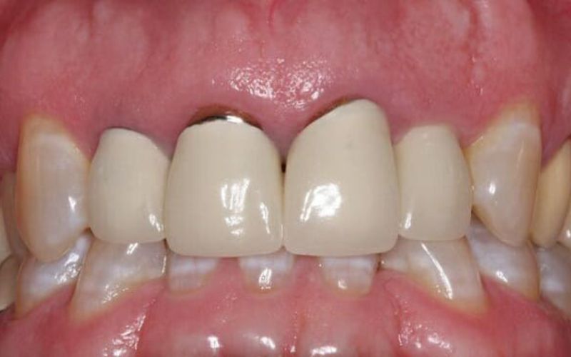 răng sứ lava 3m