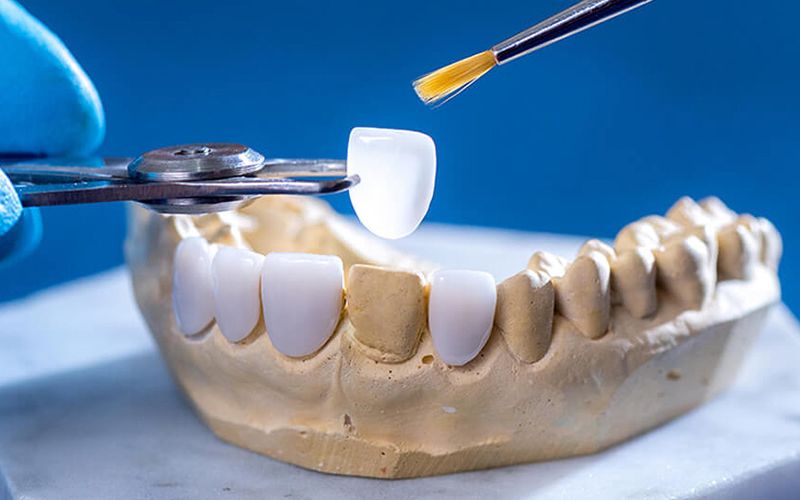 răng sứ orodent